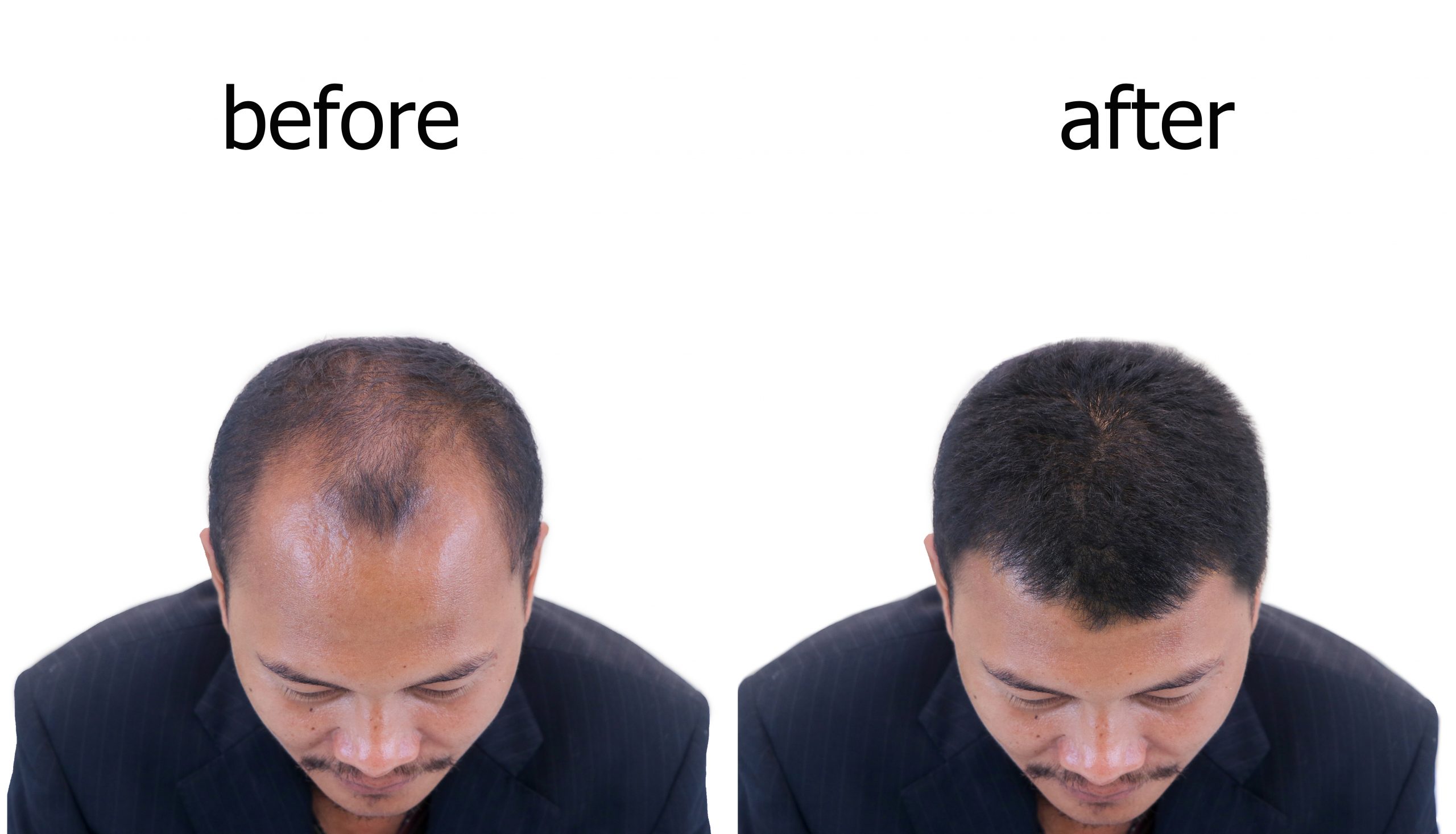 Hair Male Before After